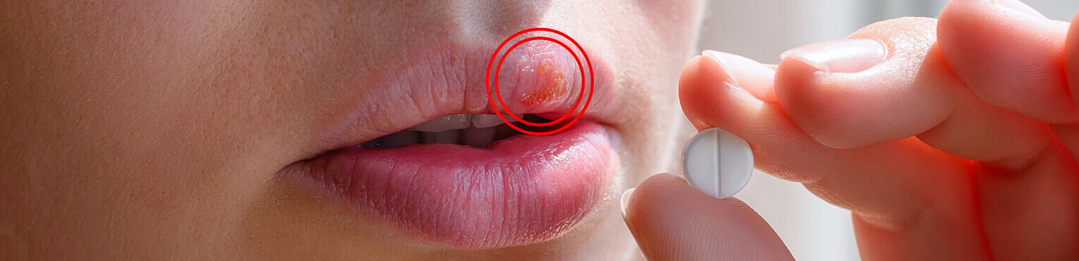 Czym skutecznie leczyć opryszczkę