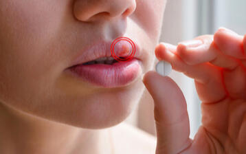 Czym skutecznie leczyć opryszczkę