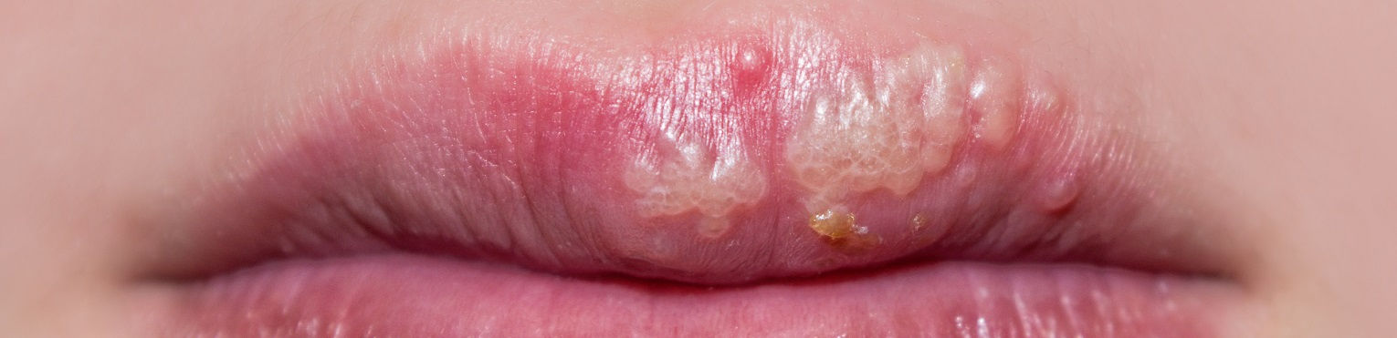 Fazy opryszczki wargowej - jak przebiega i ile trwa?