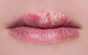Fazy opryszczki wargowej - jak przebiega i ile trwa?