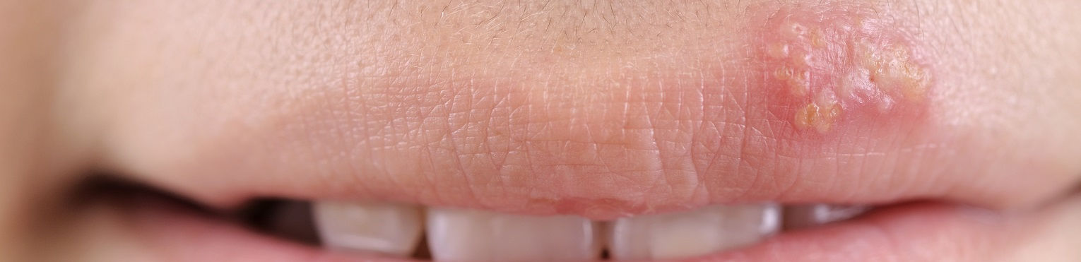 Pęcherzyki na ustach - czy to opryszczka? 