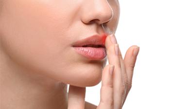 Pieczenie ust - czy to opryszczka? Przyczyny 