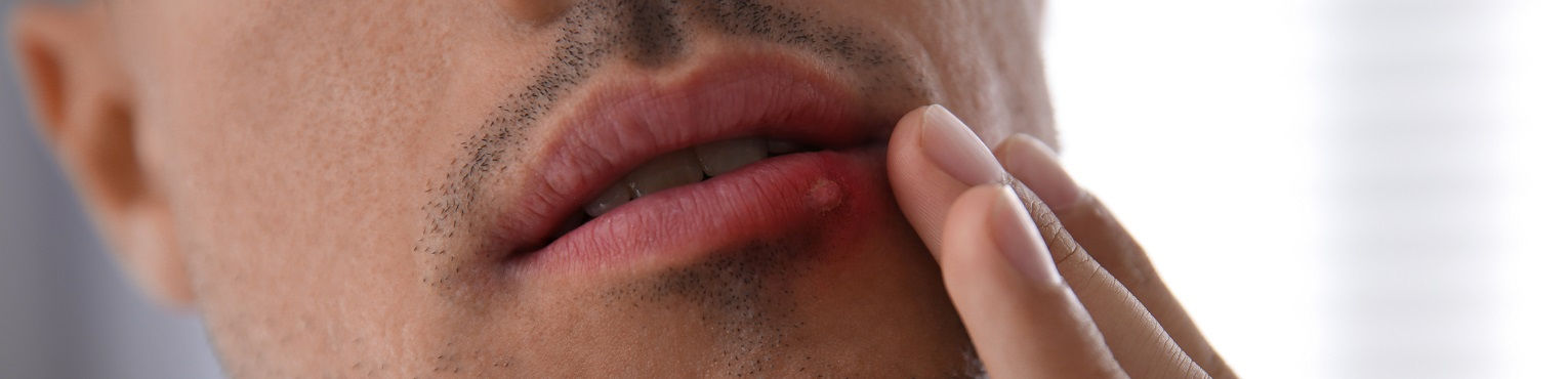 Zimno na ustach - jak zapobiegać? Sposoby