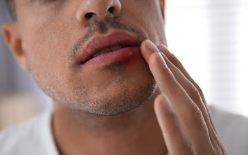 Zimno na ustach - jak zapobiegać? Sposoby